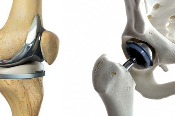 Joint Replacement